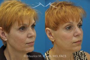 Photo of a patient before and after a procedure. Saddle Nose - before-and-after composite photo.