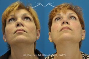 Photo of a patient before and after a procedure. Saddle Nose - before-and-after composite photo.