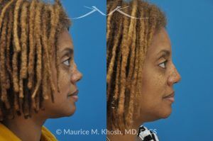 Photo of a patient before and after a procedure. Saddle Nose - before-and-after composite photo.