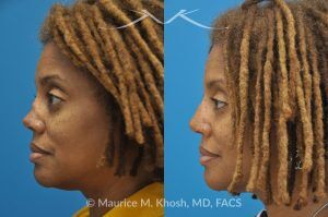 Photo of a patient before and after a procedure. Saddle Nose - before-and-after composite photo.