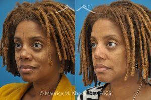 Photo of a patient before and after a procedure. Saddle Nose - before-and-after composite photo.