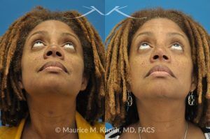 Photo of a patient before and after a procedure. Saddle Nose - before-and-after composite photo.