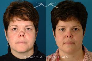 Photo of a patient before and after a procedure. Saddle Nose - before-and-after composite photo.