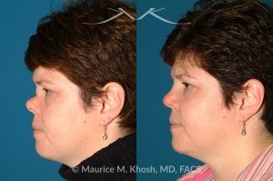 Photo of a patient before and after a procedure. Saddle Nose - before-and-after composite photo.