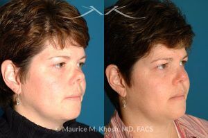 Photo of a patient before and after a procedure. Saddle Nose - before-and-after composite photo.