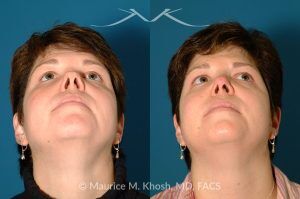 Photo of a patient before and after a procedure. Saddle Nose - before-and-after composite photo.