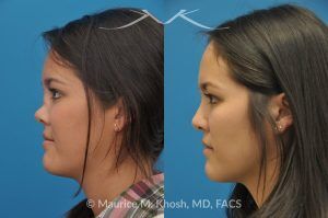 Photo of a patient before and after a procedure. Saddle Nose - before-and-after composite photo.