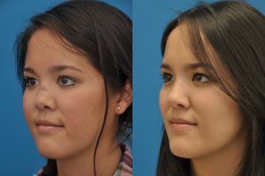 Photo of a patient before and after a procedure. Saddle Nose - before-and-after composite photo.