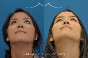 Photo of a patient before and after a procedure. Saddle Nose - before-and-after composite photo.