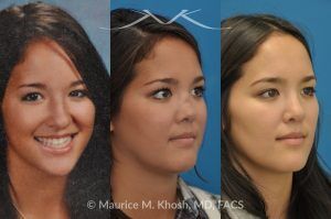 Photo of a patient before and after a procedure. Saddle Nose - before-and-after composite photo.
