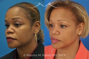 Photo of a patient before and after a procedure. Saddle Nose - before-and-after composite photo.
