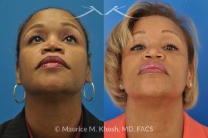 Photo of a patient before and after a procedure. Saddle Nose - before-and-after composite photo.