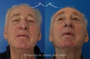 Photo of a patient before and after a procedure. Nasal valve repair and revision rhinoplasty - This 73 year old had previously undergone rhinoplasty in his 20's. The surgery had left his nose deformed and severely obstructed. Revision rhinoplasty and repair of nasal vestibular stenosis was accomplished with use of cadaver rib cartilage. Revision surgery helped to restore a natural shape to the nose, and alleviate his breathing issues. He is delighted with the surgical results.