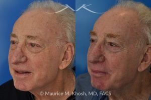 Photo of a patient before and after a procedure. Nasal valve repair and revision rhinoplasty - This 73 year old had previously undergone rhinoplasty in his 20's. The surgery had left his nose deformed and severely obstructed. Revision rhinoplasty and repair of nasal vestibular stenosis was accomplished with use of cadaver rib cartilage. Revision surgery helped to restore a natural shape to the nose, and alleviate his breathing issues. He is delighted with the surgical results.