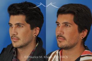 Photo of a patient before and after a procedure. Revision rhinoplasty for cleft lip nose deformity - This 24 year-old with congenital cleft lip nasal deformity had previously undergone surgery on his nose. As a result of that previous surgery the nose tip had become overly up-turned and the middle vault of the nose was pinched appearing. The right nostril base was depressed relative to the normal left side. Revision rhinoplasty in New York was performed with rib cartilage which was harvested from the patient's own chest. The 7 month results (on the left side) show a dramatic improvement in regards to the shape and position of the nasal tip, middle vault of the nose, and the position of the right nostril base. 