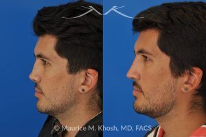Photo of a patient before and after a procedure. Revision rhinoplasty for cleft lip nose deformity - This 24 year-old with congenital cleft lip nasal deformity had previously undergone surgery on his nose. As a result of that previous surgery the nose tip had become overly up-turned and the middle vault of the nose was pinched appearing. The right nostril base was depressed relative to the normal left side. Revision rhinoplasty in New York was performed with rib cartilage which was harvested from the patient's own chest. The 7 month results (on the left side) show a dramatic improvement in regards to the shape and position of the nasal tip, middle vault of the nose, and the position of the right nostril base. 