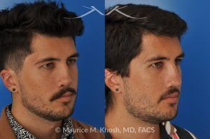 Photo of a patient before and after a procedure. Revision rhinoplasty for cleft lip nose deformity - This 24 year-old with congenital cleft lip nasal deformity had previously undergone surgery on his nose. As a result of that previous surgery the nose tip had become overly up-turned and the middle vault of the nose was pinched appearing. The right nostril base was depressed relative to the normal left side. Revision rhinoplasty in New York was performed with rib cartilage which was harvested from the patient's own chest. The 7 month results (on the left side) show a dramatic improvement in regards to the shape and position of the nasal tip, middle vault of the nose, and the position of the right nostril base. 