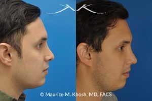 Photo of a patient before and after a procedure. Revision rhinoplasty to improve breathing and refine the tip - This 31 year old had previously undergone a nose job operation at age 17. He had breathing difficulty from both sides of the nose. He also disliked the flat, wide, asymmetric, and under-projected appearance of the tip of the nose. Revision rhinoplasty was performed to restore breathing and improve the appearance of the tip of the nose. Open approach rhinopalsty was used to place bilateral spreader grafts, left alar strut graft, narrow the tip, and improve the projection of the tip of the nose.