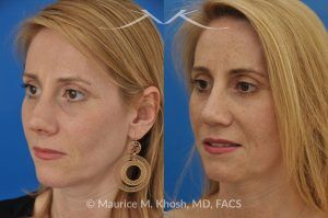 Photo of a patient before and after a procedure. Revision tip rhinoplasty with cartilage graft - This young lady complained of difficulty breathing, significant asymmetry of the nasal tip, and unnatural tip appearance on profile view of the nose following her primary rhinoplasty. The tip symmetry was restored and profile appearance was improved through revision tip rhinoplasty with cartilage grafts.