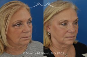 Photo of a patient before and after a procedure. Botox for Brow and Smile Lines with Voluma Filler - Patient treated with Botox for the brow and smile lines, and Voluma facial filler for the cheeks, temples, tear trough, and side of the lower jaw. Although no eyelid surgery was performed, the lower eyelids appear rejuvenated.
