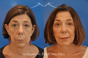 Photo of a patient before and after a procedure. Endoscopic Brow Lift with Revision SMAS Facelift and Eyelid Surgery - This 65 year old lady had previously undergone a facelift operation at age 48. She was unhappy with the aged appearance of her brow, eyes, mouth, and neck which made her look tired and sad. She underwent Revision SMAS facelift, endoscopic brow lift, upper and lower blepharoplasty.