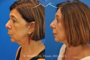 Photo of a patient before and after a procedure. Endoscopic Brow Lift with Revision SMAS Facelift and Eyelid Surgery - This 65 year old lady had previously undergone a facelift operation at age 48. She was unhappy with the aged appearance of her brow, eyes, mouth, and neck which made her look tired and sad. She underwent Revision SMAS facelift, endoscopic brow lift, upper and lower blepharoplasty.