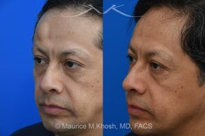 Photo of a patient before and after a procedure. Endoscopic Forehead Lipoma Removal with Hidden Hairline Incision - The lipoma in this picture had been enlarging over a number of years. The patient wished to avoid a visible scar in the forehead. We utilized an endoscopic approach within the hairline to remove this large lipoma. The forehead is now perfectly smooth and there is NO visible scar from the endoscopic approach. 