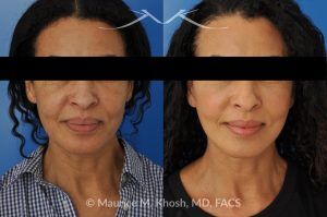 Photo of a patient before and after a procedure. Facelift for Natural Facial Rejuvenation and Lower Face Contouring - This delightful 57 year old desired a younger looking and natural enhancement of her face. Facelift surgery in New York was performed under local anesthesia as an office procedure. The before and after photos demonstrate her results 2 months after surgery. Notes the improved contour of the chin and jowls. The heavy-looking and squared appearing lower face has been transformed to a heart shaped lower face. The new and improved look is complementary and natural appearing. The patient is thrilled with her beautiful results. 
