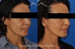 Photo of a patient before and after a procedure. Facelift for Natural Facial Rejuvenation and Lower Face Contouring - This delightful 57 year old desired a younger looking and natural enhancement of her face. Facelift surgery in New York was performed under local anesthesia as an office procedure. The before and after photos demonstrate her results 2 months after surgery. Notes the improved contour of the chin and jowls. The heavy-looking and squared appearing lower face has been transformed to a heart shaped lower face. The new and improved look is complementary and natural appearing. The patient is thrilled with her beautiful results. 
