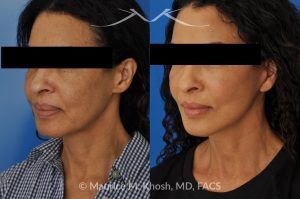Photo of a patient before and after a procedure. Facelift for Natural Facial Rejuvenation and Lower Face Contouring - This delightful 57 year old desired a younger looking and natural enhancement of her face. Facelift surgery in New York was performed under local anesthesia as an office procedure. The before and after photos demonstrate her results 2 months after surgery. Notes the improved contour of the chin and jowls. The heavy-looking and squared appearing lower face has been transformed to a heart shaped lower face. The new and improved look is complementary and natural appearing. The patient is thrilled with her beautiful results. 
