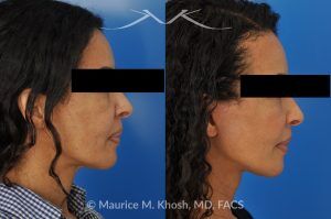 Photo of a patient before and after a procedure. Facelift for Natural Facial Rejuvenation and Lower Face Contouring - This delightful 57 year old desired a younger looking and natural enhancement of her face. Facelift surgery in New York was performed under local anesthesia as an office procedure. The before and after photos demonstrate her results 2 months after surgery. Notes the improved contour of the chin and jowls. The heavy-looking and squared appearing lower face has been transformed to a heart shaped lower face. The new and improved look is complementary and natural appearing. The patient is thrilled with her beautiful results. 
