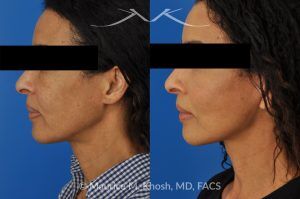 Photo of a patient before and after a procedure. Facelift for Natural Facial Rejuvenation and Lower Face Contouring - This delightful 57 year old desired a younger looking and natural enhancement of her face. Facelift surgery in New York was performed under local anesthesia as an office procedure. The before and after photos demonstrate her results 2 months after surgery. Notes the improved contour of the chin and jowls. The heavy-looking and squared appearing lower face has been transformed to a heart shaped lower face. The new and improved look is complementary and natural appearing. The patient is thrilled with her beautiful results. 
