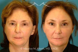Photo of a patient before and after a procedure. Brow Lift - before and after photo.