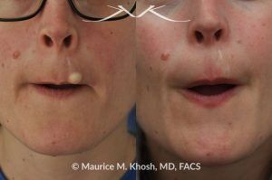 Photo of a patient before and after a procedure. Upper Lip Cyst Removal - This procedure involved the excision of a cyst from the upper lip, successfully removing the growth and improving the appearance of the affected area.
