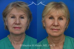 Photo of a patient before and after a procedure. Temporal Brow Lift with Lower Blepharoplasty and Deep Plane Facelift - Our delightful patient was interested in overall facial rejuvenation. She underwent lower blepharoplasty with orbital fat repositioning, temporal brow lift, and a deep plane facelift. She is ecstatic with her surgical results.