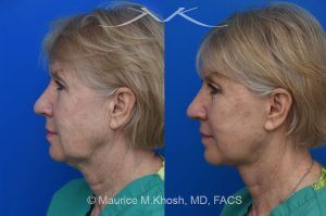 Photo of a patient before and after a procedure. Temporal Brow Lift with Lower Blepharoplasty and Deep Plane Facelift - Our delightful patient was interested in overall facial rejuvenation. She underwent lower blepharoplasty with orbital fat repositioning, temporal brow lift, and a deep plane facelift. She is ecstatic with her surgical results.