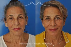 Photo of a patient before and after a procedure. Facelift and Neck Lift for Lower Face and Neck Rejuvenation - This delightful 68-year old underwent facelift and neck lift surgery to rejuvenate the lower face and neck area. The SMAS facelift allowed resolution of her jowls and sagging cheeks. The neck lift procedure helped to improve the sagging neck, and the skin hanging in the neck. She is ecstatic with the beautiful and natural results of her facelift and neck lift.