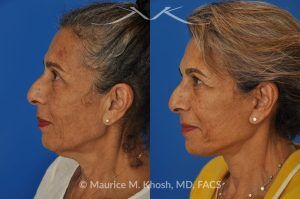 Photo of a patient before and after a procedure. Facelift and Neck Lift for Lower Face and Neck Rejuvenation - This delightful 68-year old underwent facelift and neck lift surgery to rejuvenate the lower face and neck area. The SMAS facelift allowed resolution of her jowls and sagging cheeks. The neck lift procedure helped to improve the sagging neck, and the skin hanging in the neck. She is ecstatic with the beautiful and natural results of her facelift and neck lift.