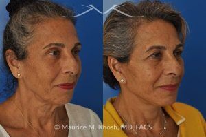 Photo of a patient before and after a procedure. Facelift and Neck Lift for Lower Face and Neck Rejuvenation - This delightful 68-year old underwent facelift and neck lift surgery to rejuvenate the lower face and neck area. The SMAS facelift allowed resolution of her jowls and sagging cheeks. The neck lift procedure helped to improve the sagging neck, and the skin hanging in the neck. She is ecstatic with the beautiful and natural results of her facelift and neck lift.