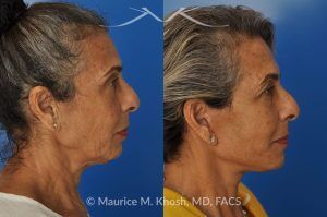 Photo of a patient before and after a procedure. Facelift and Neck Lift for Lower Face and Neck Rejuvenation - This delightful 68-year old underwent facelift and neck lift surgery to rejuvenate the lower face and neck area. The SMAS facelift allowed resolution of her jowls and sagging cheeks. The neck lift procedure helped to improve the sagging neck, and the skin hanging in the neck. She is ecstatic with the beautiful and natural results of her facelift and neck lift.