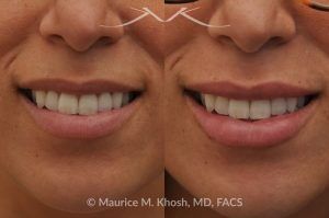 Photo of a patient before and after a procedure. Lip Augmentation with Hyaluronic Acid Filler - This 33-year-old young woman was interested in a beautiful and natural augmentation of her lips. She wanted more voluptuous and sexy lips without appearing puffy or over-done. Hyaluronic acid filler was used to give her a subtle but noticeable improvement.