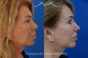 Photo of a patient before and after a procedure. Upper Lip Rejuvenation Surgery - This 65 year old desired a rejuvenated upper lip. She noted the upper lip to be excessively long, covering her upper teeth and giving her a tired and aged appearance. Lip fillers only exacerbated the problem. The post op photos on the right side show her results at 6 months after surgery.