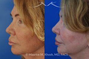 Photo of a patient before and after a procedure. Upper Lip Rejuvenation Surgery - This 65 year old desired a rejuvenated upper lip. She noted the upper lip to be excessively long, covering her upper teeth and giving her a tired and aged appearance. Lip fillers only exacerbated the problem. The post op photos on the right side show her results at 6 months after surgery.
