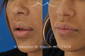 Photo of a patient before and after a procedure. Lip Reduction - Lip reduction to improve the swollen appearing upper lip, which was caused by Silocone injection of the lips