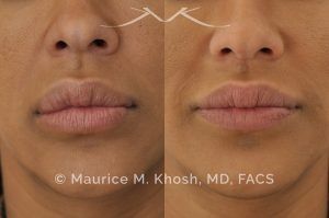 Photo of a patient before and after a procedure. Lip Reduction - Lip reduction to improve the swollen appearing upper lip, which was caused by Silocone injection of the lips.