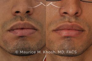Photo of a patient before and after a procedure. Lip Scar Revision - Lip scar revision to improve a depressed scar in the right lower lip, near the corner.