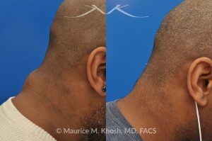 Photo of a patient before and after a procedure. Posterior Neck Lipoma Removal - 44 year old with recurrent lipoma in the posterior aspect of the neck requested lipoma removal in our New York office. The right side photos demonstrate the successful outcome of surgery 4 months post op.