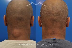 Photo of a patient before and after a procedure. Posterior Neck Lipoma Removal - 44 year old with recurrent lipoma in the posterior aspect of the neck requested lipoma removal in our New York office. The right side photos demonstrate the successful outcome of surgery 4 months post op.