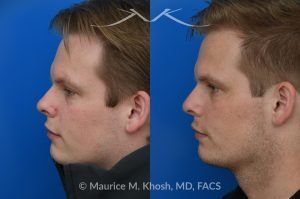 Photo of a patient before and after a procedure. Rhinoplasty with Spreader Graft Improved Symmetry and Breathing - This young patient presented with complaints of nasal obstruction and asymmetric nasal appearance on front view. He had a severe septum deviation and narrowing of the right internal nasal valve due to medial positioning of the upper lateral cartilage. Surgery was performed through a closed approach. Septoplasty was followed by placement of a spreader graft on the right side. The spreader graft not only improved breathing, it also widened the right middle vault and enhanced symmetry of the upper nose in the frontal view.
