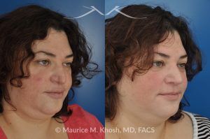 Photo of a patient before and after a procedure. Nasal Valve Repair with Rib Cartilage Graft - Nasal valve repair (repair of nasal vestibular stenosis) with rib cartilage graft.